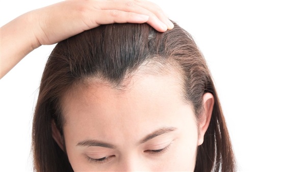 كيفية علاج ومجابهة انحسار خط الشعر لدى النساء - دار الهلال
